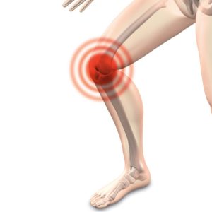 How to Treat a Swollen Knee